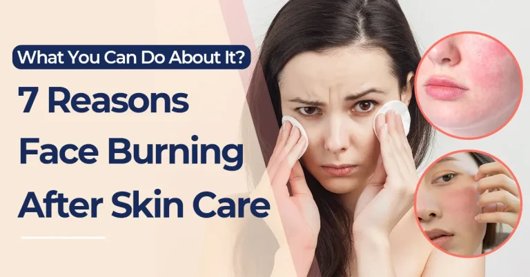 CALLA blog cover image showing face burning after skin care with redness