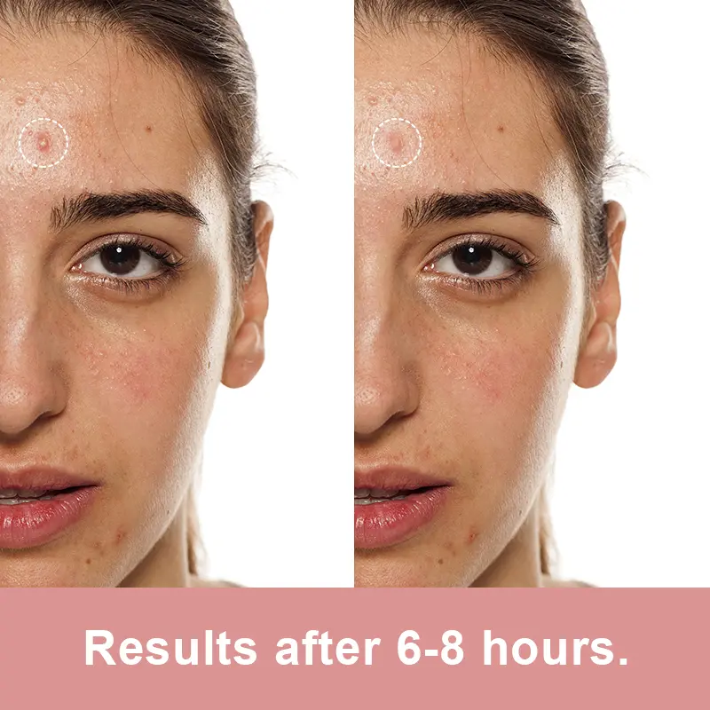 acne-patches-6hr-result Results after 6 hours using hydrocolloid acne patches, private label