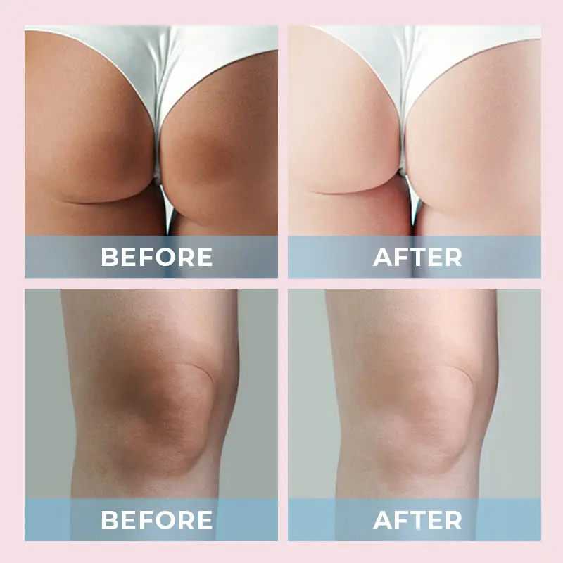 calla-brightening-cream-underarm-buttocks-knees-lightening كريم تفتيح البشرة CALLA في عبوة عبوات سوداء للعناية بالبشرة بعلامة تجارية خاصة، يظهر تفتيح البشرة تحت الإبطين والأرداف والركبتين